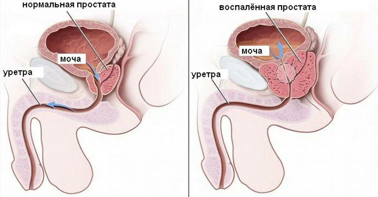 Расположение простаты у мужчин. Рисунок простаты у мужчин. Простатоцистит