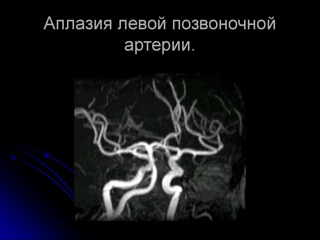 Гипоплазия позвоночной артерии кт. Гипоплазия правой позвоночной артерии на кт. Гипоплазия v4 позвоночной артерии. Гипоплазия мозговой артерии.