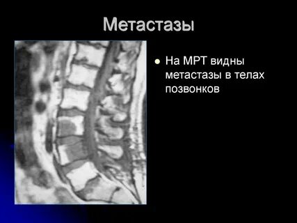 Метастазы в позвоночнике