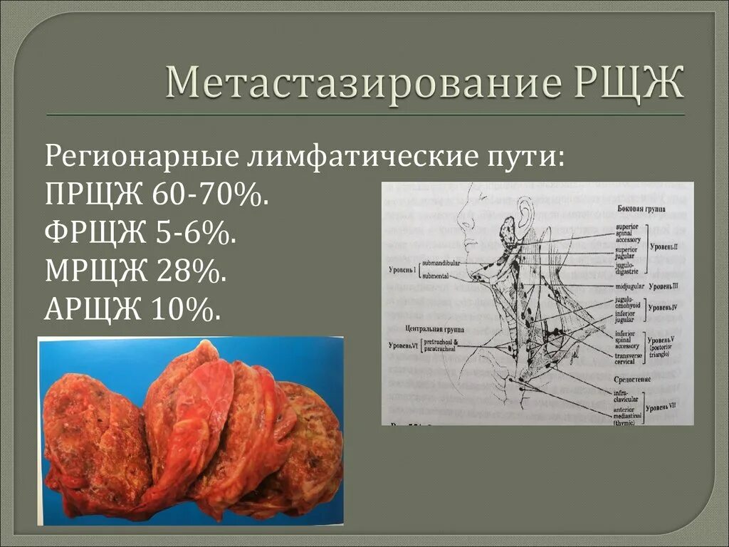 Рак щитовидной сколько живут