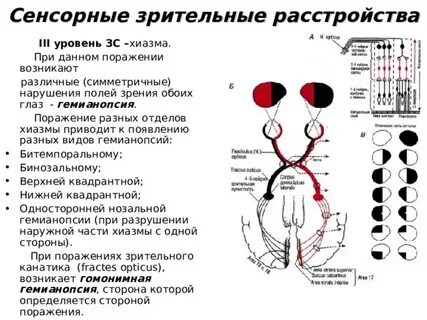 Синдром зрительных нарушений