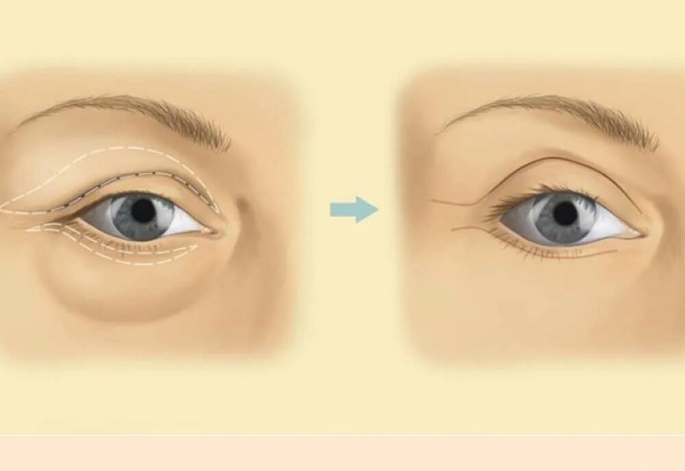 Как изменяются века. Пальпебральная складка верхнего века анатомия. Нависающая складка верхнего века.