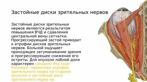 Застойный зрительного нерва