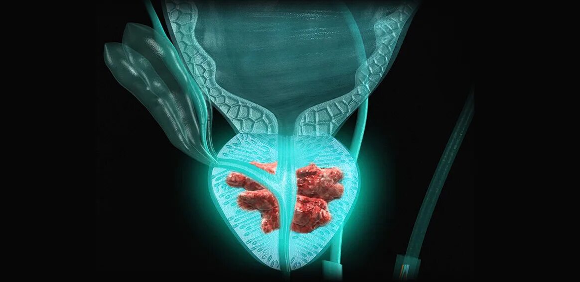 Предстательная железа 3д. PSMA предстательной железы. Cancer предстательной железы. Злокачественное новообразование предстательной железы.