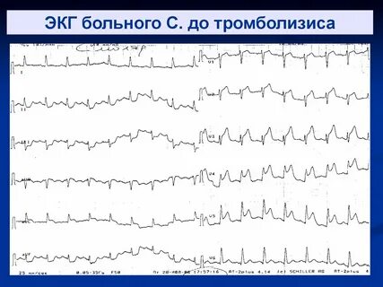 Экг пациентов