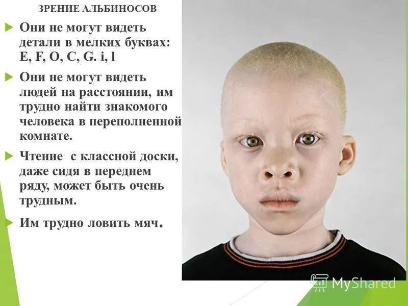 Альбинизм хромосомная мутация. Альбиносы люди. Альбинос парень.