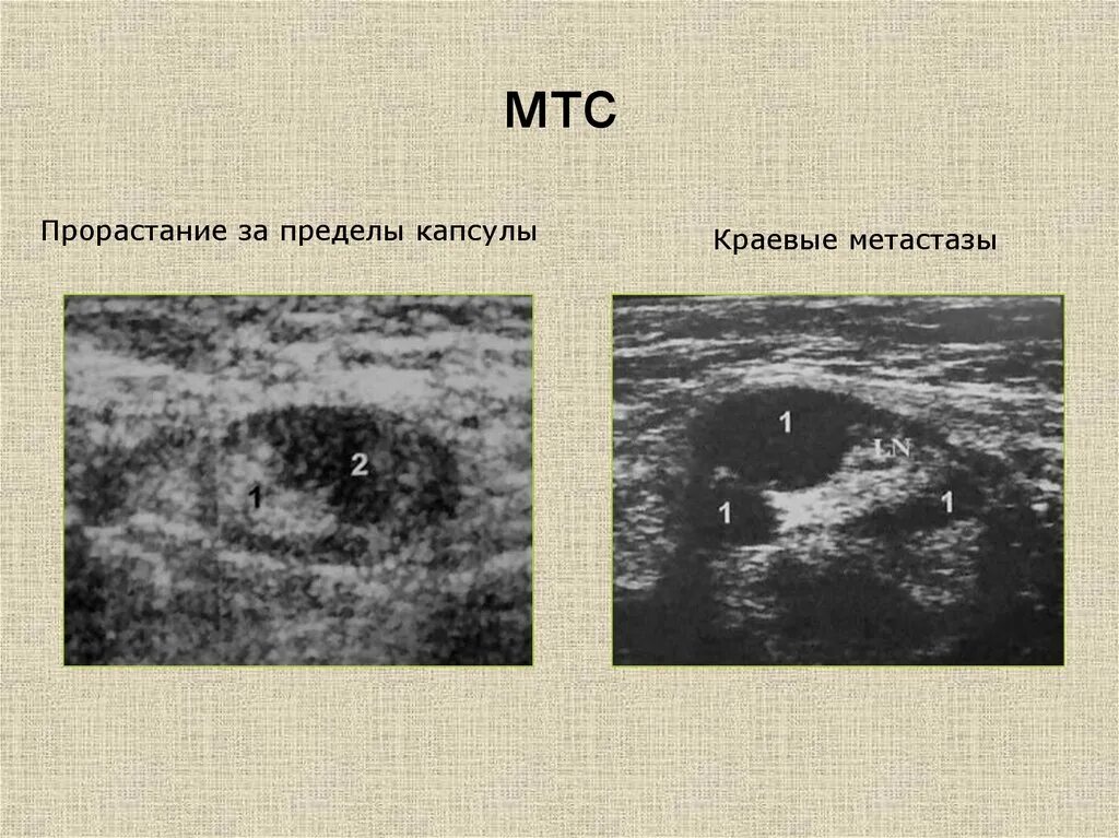 Метастазы лимфоузлов на УЗИ. Метастазы в лимфоузлах на УЗИ. Метастазы в лимфоузлы на УЗИ. Метастазы в лимфоузлы насузи. Метастатические лимфоузлы