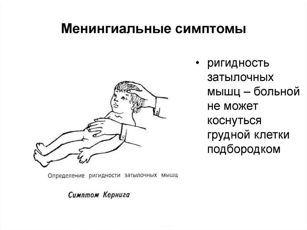 Менингококковая инфекция симптом Кернига. Менингеальные симптомы ригидность затылочных мышц. Ригидность мышц затылка, симптомы Кернига, Брудзинского. Ригидность мышц при менингите у детей.