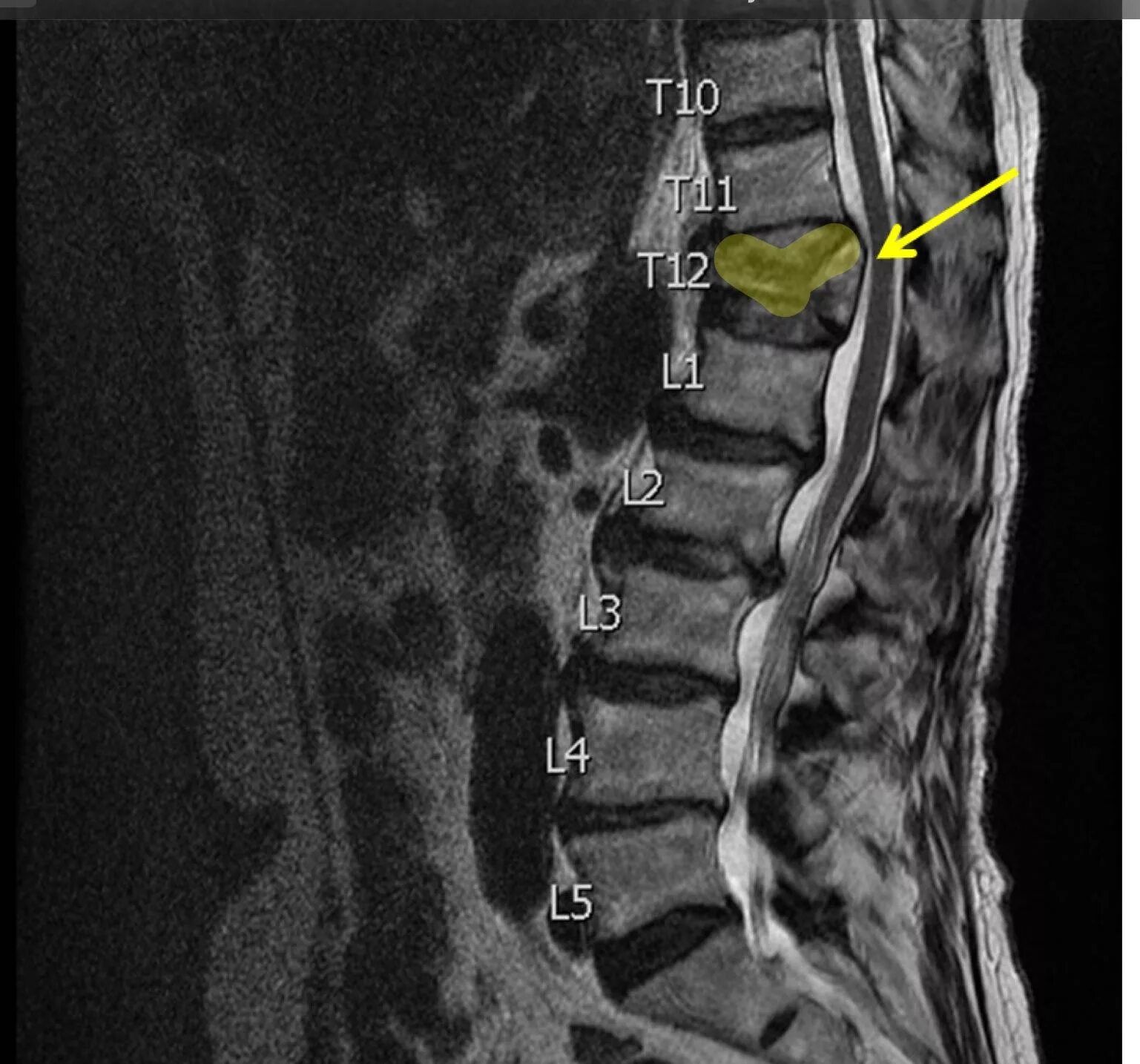 Компрессионный перелом позвоночника th12 l3. Компрессионный перелом тела т11 позвонка. Компрессионный перелом th11 позвонка. Компрессионный перелом позвоночника l4,l5. Компрессионный перелом тела 1 1