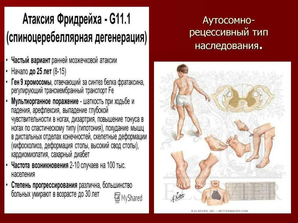 Атаксия при движении. Наследственные атаксии болезнь фридрейха. болезнь фридрейха патогенез. мозжечковая атаксия фридрейха. мозжечковая атаксия болезнь фридрейха.