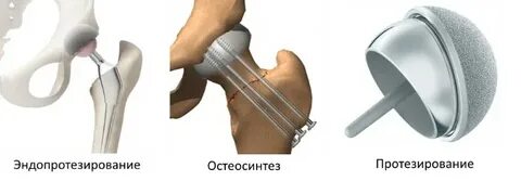 Операция при переломе шейки бедра в пожилом
