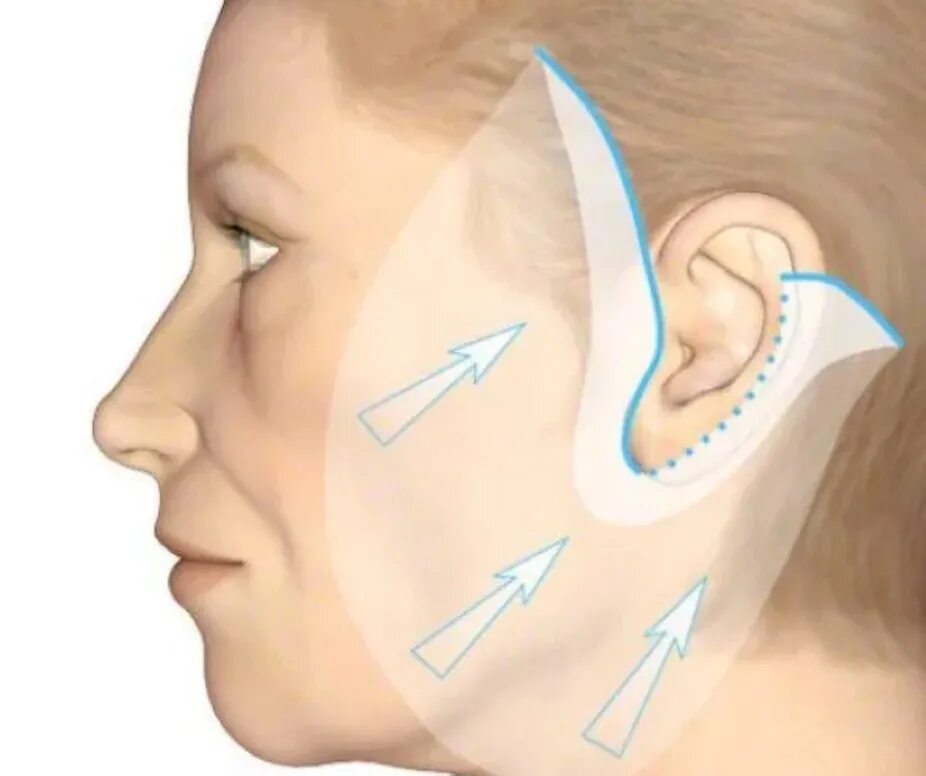 Подтяжка лица около ушей. Разрезы при круговой подтяжке лица.