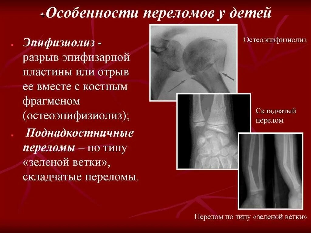 Перелом у детей симптомы. Особенности переломов у детей. поднадкостничные переломы по типу зеленой веточки. поднадкостничный перелом характеристика. рентгенодиагностика переломов.