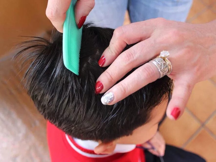 Блохи в волосах на голове. Эпидемия вшей. Эпидемия вшей. Эпидемия вшей. Педикулез волосистой части головы.