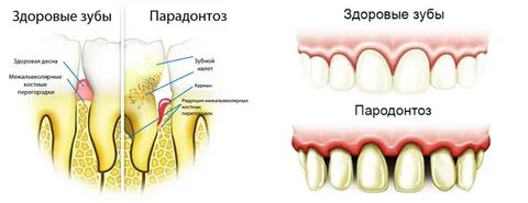Парадонтозные зубы