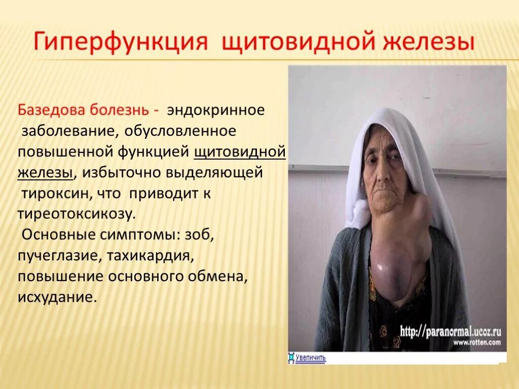 При гиперфункции щитовидной железы основной обмен. Гиперфункция щитовидной железы. гипер функция щитовидной железх. гиперфункция щитовидной железы болезни. гиперфункция щитовидной железы у человека приводит к заболеванию.