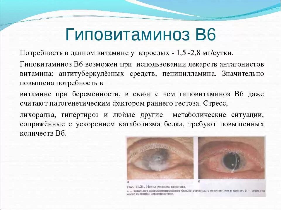 Недостаток б6. Витамин б6 гиповитаминоз. Гиповитаминоз витамина в6. Признаки гиповитаминоза витамина в6. Гиповитаминоз b6 симптомы.