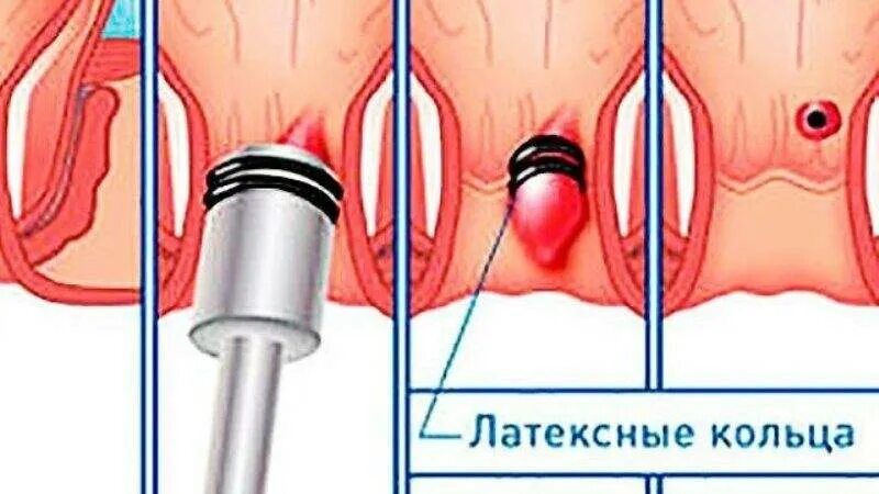 Проктолог трещины. Вакуумное лигирование геморроя. Лигирование латексными кольцами. Латексное лигирование геморроя. Вакуумное латексное лигирование.