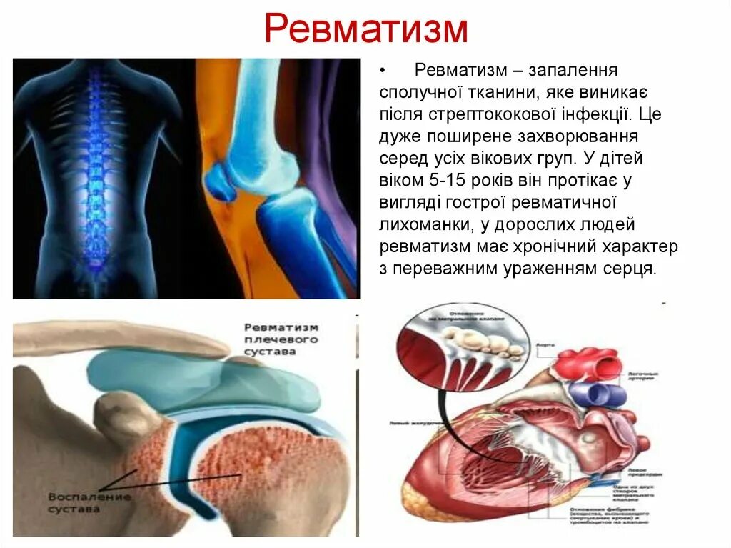 Ревматизм презентация. Remotizim.