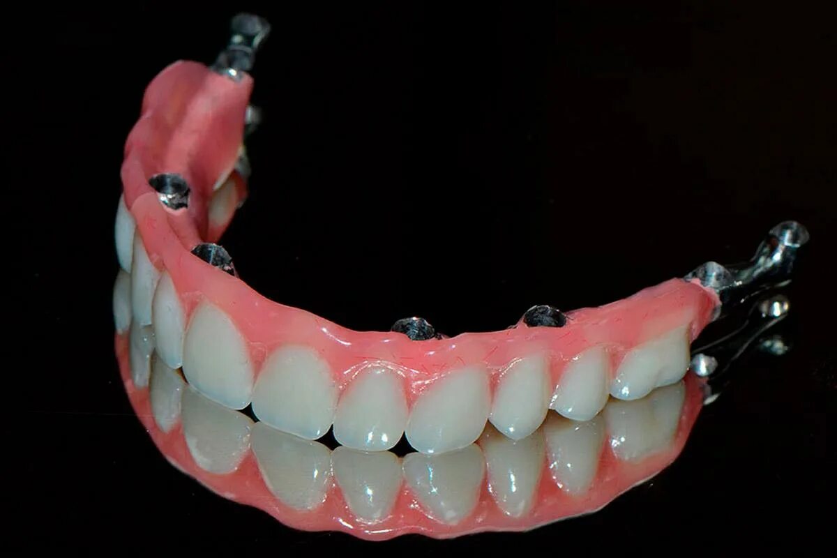 Имплантологическая кассета nobel полный набор для all on 4. Миниимпланты съемный протез. Мостовидный протез на имплантах на 4 зуба нижней челюсти. Несъемные зубные протезы на 4 имплантах. Муляж челюсти.