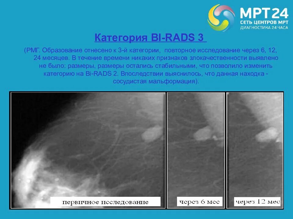 Маммография молочных желез ACR 3 birads 1. Фиброзно-кистозная мастопатия маммография bi-rads. Фиброзно-кистозная мастопатия bi-rads 2. Классификация образований молочной железы. Bi rads категория 3