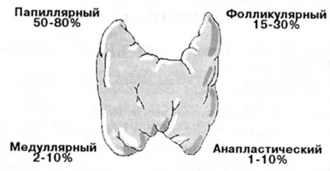 Папиллярный, медуллярный, фолликулярный. Папиллярная карцинома щитовидной железы. Рисунок папиллярная опухоль щитовидной железы. Папиллярный рак после операции