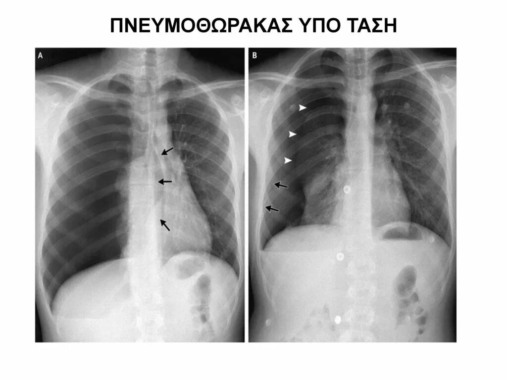 Спонтанный пневмоторакс рентген. Пневмоторакс рентген. Частичный пневмоторакс рентген. Пневмоторакс при туберкулезе легких.