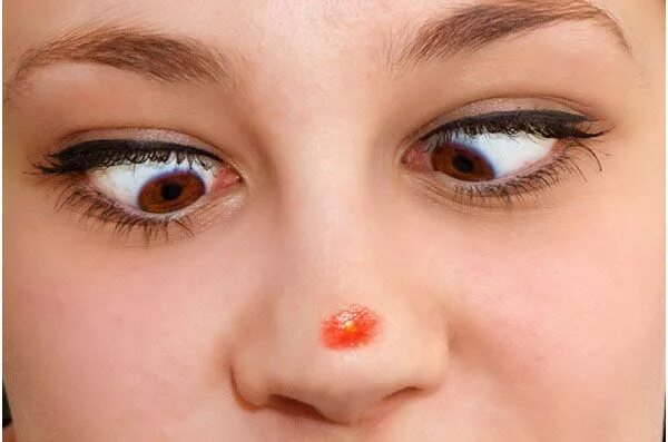 Как выглядит герпес под глазом 5 Pink Eye Symptoms to Watch For Eye health, Dry eyes, Dry eye treatment