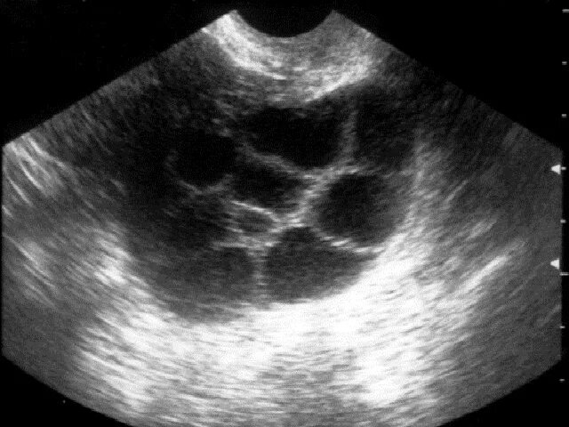 желтое тело овуляции ,желтое тело беременности. узи сразу после овуляции. овуляция на узи. наступает овуляция на узи. однояйцевая двойня на узи.
