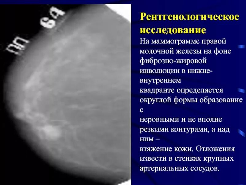 Образование молочной. Фиброзно железистая структура молочной железы. Фиброзно-кистозная инволюция. Фиброзно-жировая инволюция маммография. Жировая инволюция молочных желез маммография.