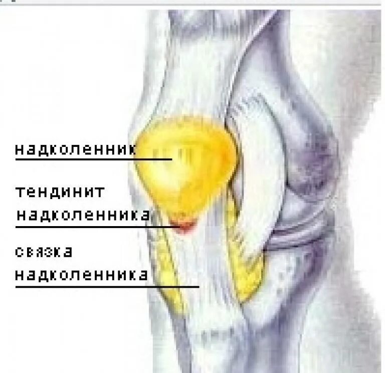 Воспаление коленных связок лечение. Повреждение сухожилия надколенника. Тендинит надколенника симптомы. Тендиноз сухожилия надколенника. Колено прыгуна тендинит надколенника.