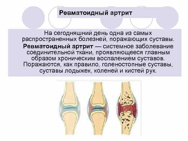 Схема поражения суставов при ревматоидном артрите. Что поражается при ревматоидном артрите. Суставы при ревматоидном артрите. Характер поражения суставов при ревматоидном артрите. Ревматоидный артрит мышцы