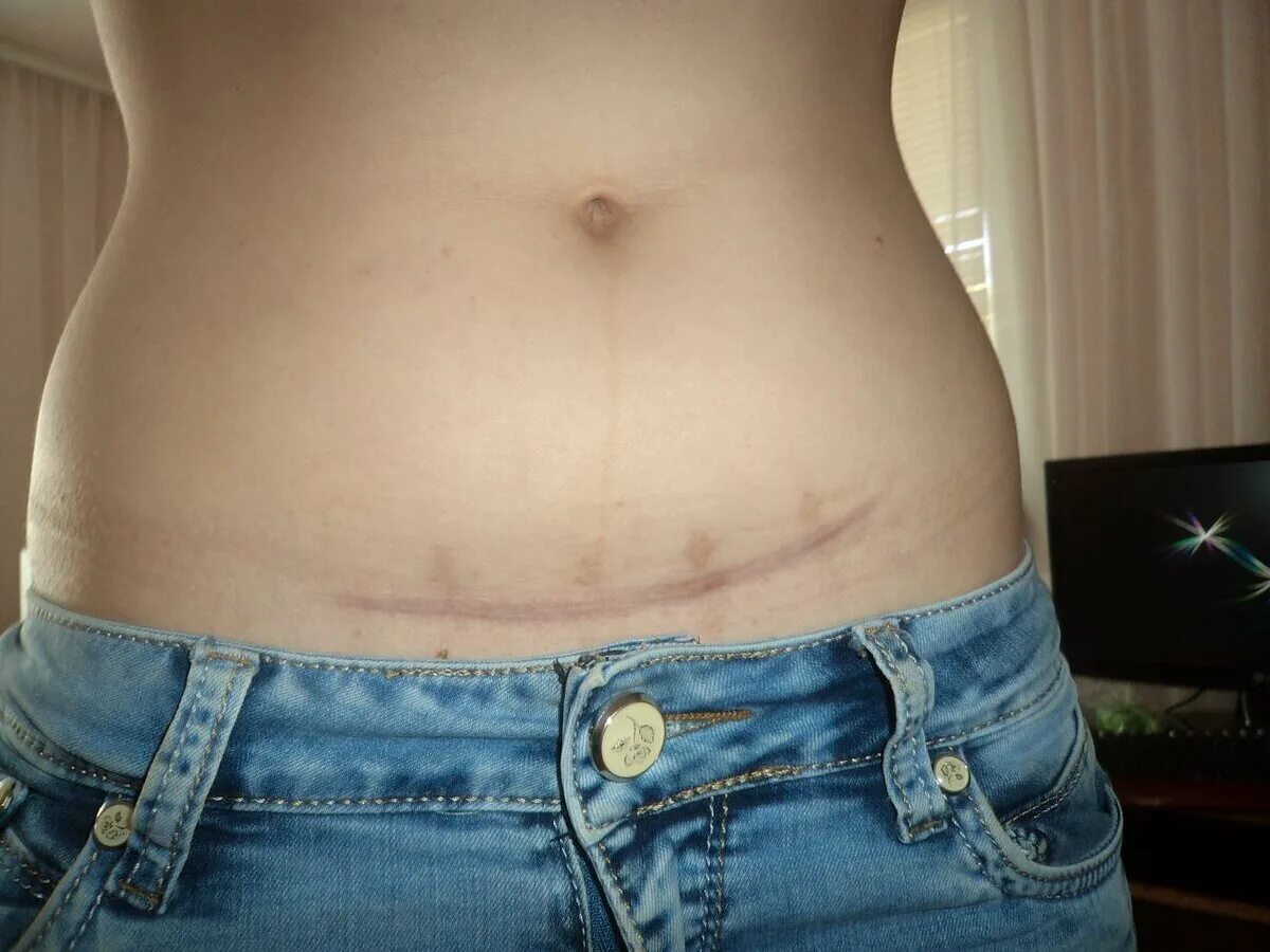 Эивот после кесоревосичения. Убрать живот над швом после кесарева. Убрать живот над швом после кесарева. Абдоминопластика восстановительный период. Упражнения после кесарева сечения для похудения живота.