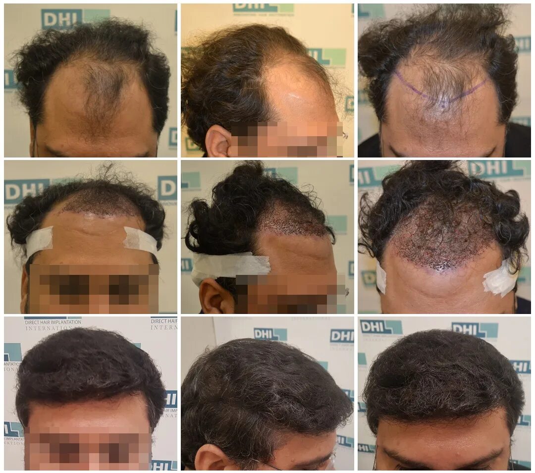 DHI трансплантация волос. Трансплантация волос DHI методом. Трансплантация волос на голове.