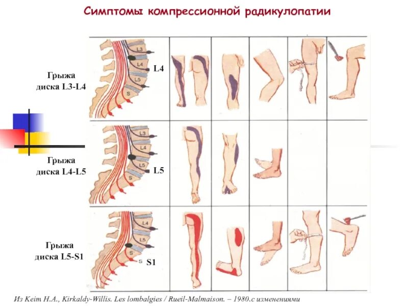 Лечится ли радикулопатия. Радикулопатия корешков л5. Радикулопатия слева. Боль при радикулопатии. Компрессионная радикулопатия l5 справа.