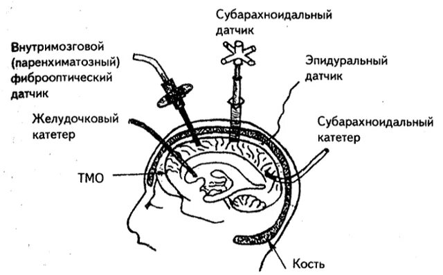 Как померить внутричерепное давление