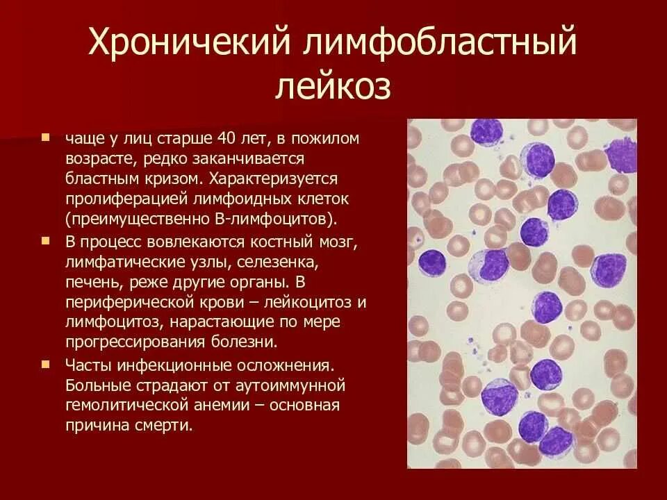 Лимфобластный лейкоз в2 клеточный. Острый лимфоидный лейкоз. Острый лимфобластный лейкоз l1. Картина острого лимфобластного лейкоза. Лейкоз характеризуется