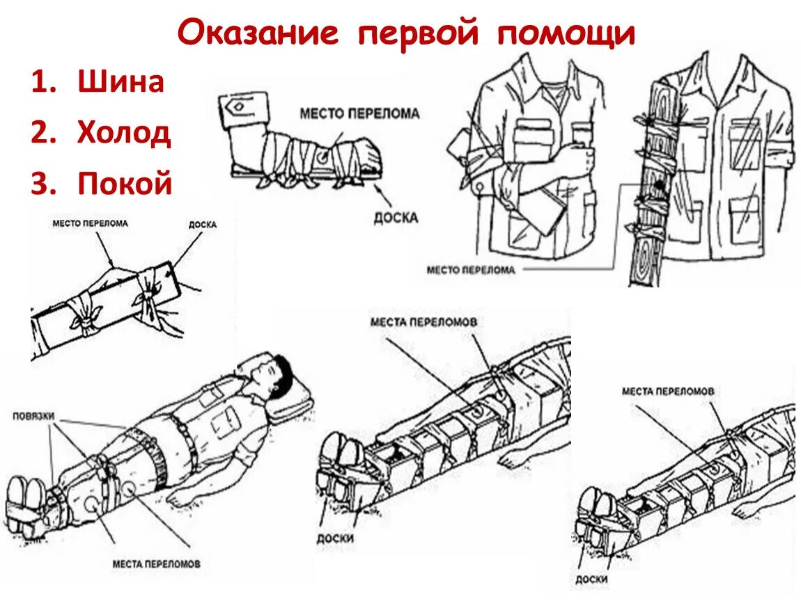 Виды переломов 1 помощь. Первая помощь при переломах. перелом оказание первой помощи. оказание помощи при переломах костей. оказание первой посрш при переломах.