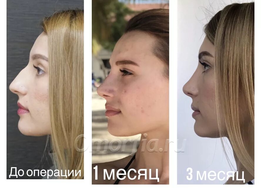 Нос после ринопластики по месяцам фото Год после ринопластики. Доктор А.Р. Андреищев Блог проекта OMORFIA