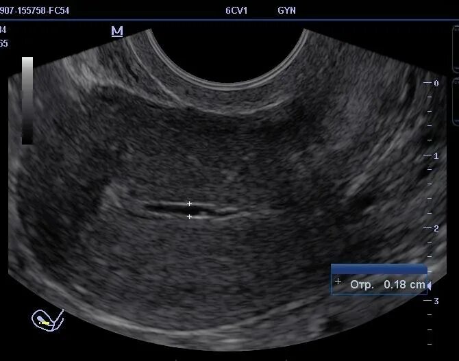 Полип после медикаментозного прерывания. УЗИ картина полипа эндометрия. Поперечный срез матки УЗИ.
