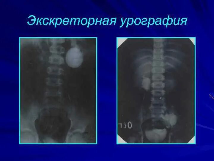 Как делается урография. Внутривенная экскреторная урография. обзорная и экскреторная урография. урография почек.