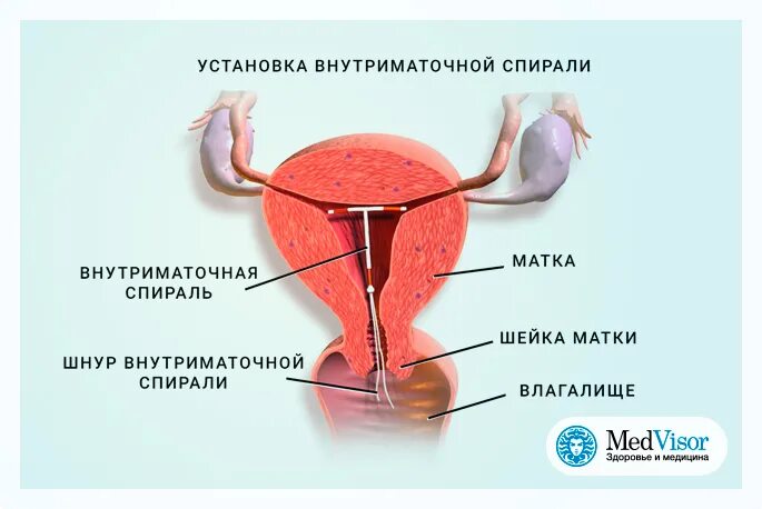 Спираль от беременности минусы. Спираль внутриматочная. Спираль ВМС. Внутриматочная спираль плюсы. Спираль внутриматочная минусы.