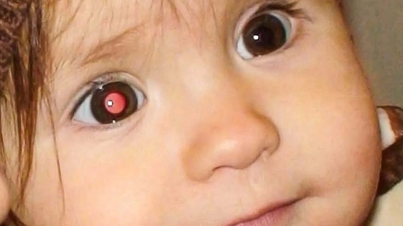 Светящиеся глаза у ребенка. Ретинобластома лейкокория. Врожденная катаракта ретинобластома. Нистагм, страбизм. Светящиеся глаза у ребенка.
