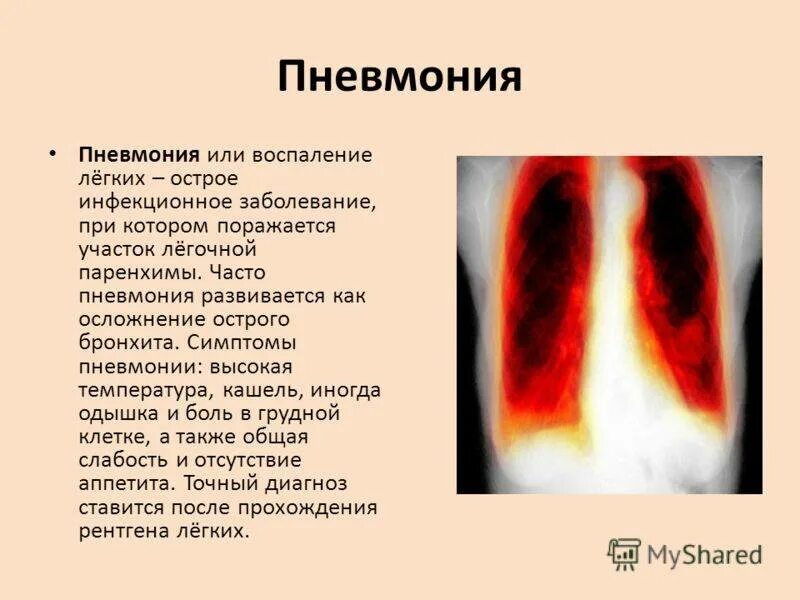 Ковид признаки у взрослых без температуры. Легочные проявления пневмонии.