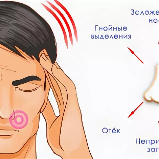 Сильные боли при гайморите