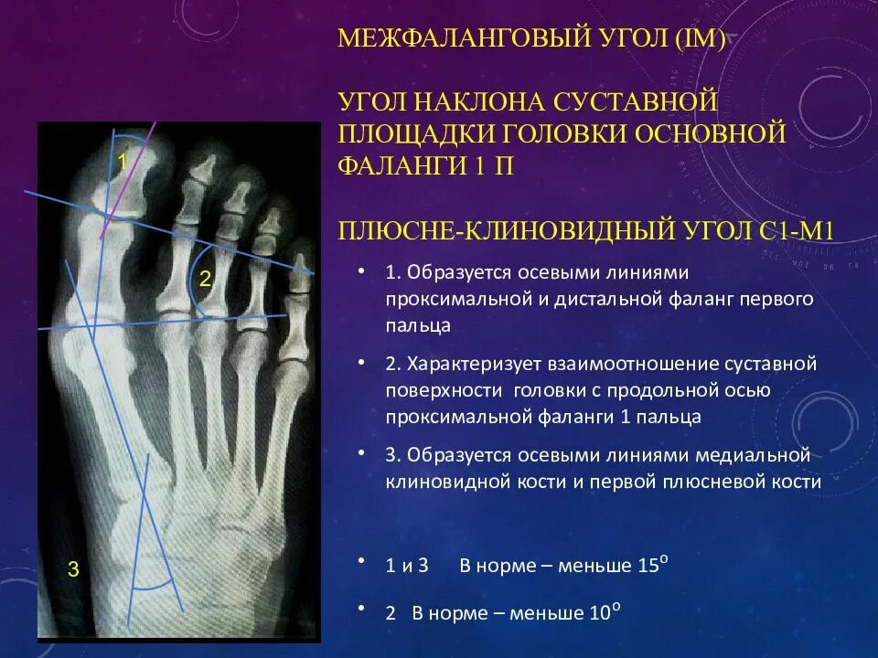Угол пальца. Дистальная фаланга плюсневой кости. проксимальные межфаланговые суставы. дистальные межфаланговые суставы. межфаланговый дистальный сустав большого пальца стопы.