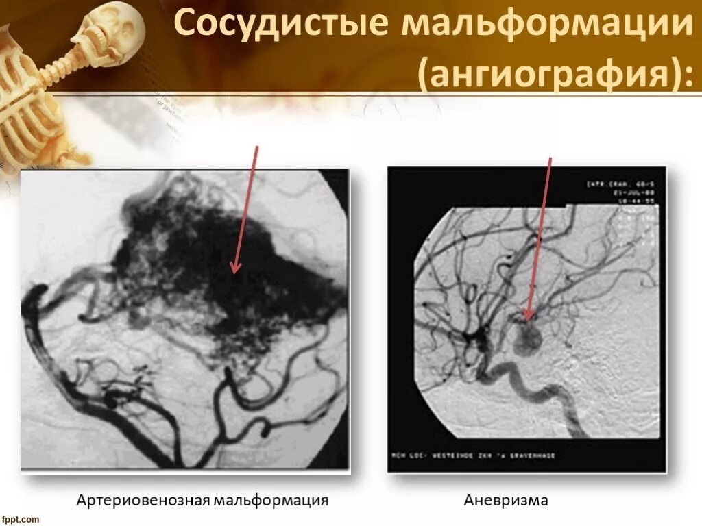Мальформация сосудов. Артериовенозная мальформация. ангиография в неврологии. ангиография мальформация.