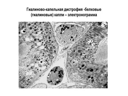 Гиалиново капельная дистрофия