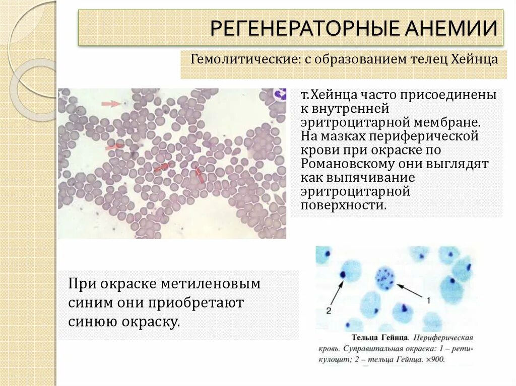 Тельца гейнца. Регенераторные и гипорегенераторные анемии. Регенераторная форма анемии. Классификация анемий по степени регенерации. По Регенераторной способности анемии.