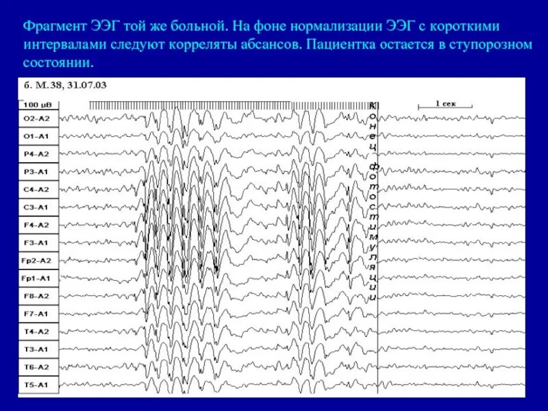 Вертексные потенциалы на ЭЭГ. Паттерны сна на ЭЭГ. ЭЭГ энцефалограмма. Джексоновская эпилепсия на ЭЭГ. Как выглядит ээг
